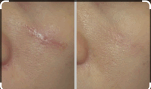 L’impatto estetico e sociale delle cicatrici