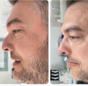 Rinofiller visto da Me