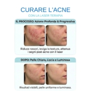 curare acne con laser terapia