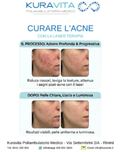 Addio Acne e Cicatrici: La Rivoluzione della Laser Terapia