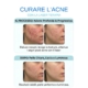 curare acne con laser terapia