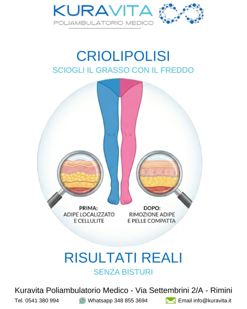 Criolipolisi e Cellulite a Rimini: Guida Kuravita