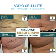 risultati mesoterapia risultati mesoterapia
