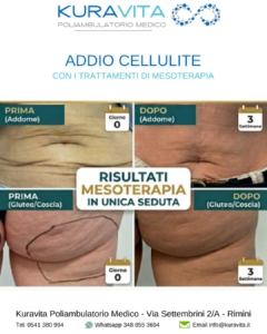Mesoterapia Rimini: Risultati in Una Sola Seduta